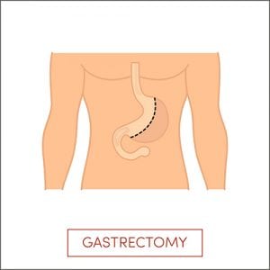 sleeve-gastrectomy-weight-loss-surgery-institute-3