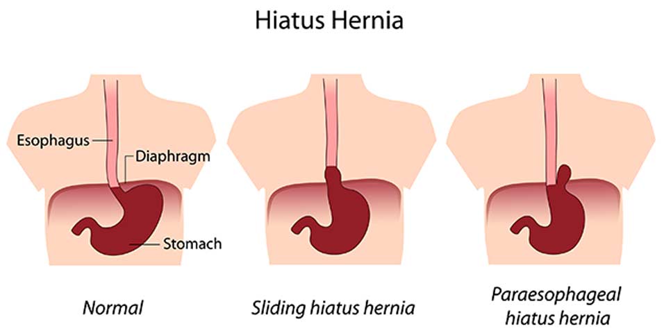 Hiatal-Hernia-Weight-Loss-Surgery-Institute-2