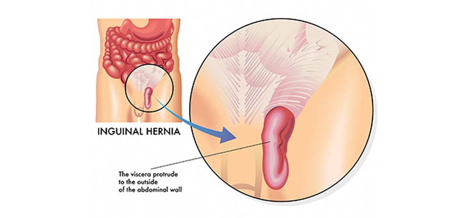Inguinal-Hernia-Weight-Loss-Surgery-Institute-1