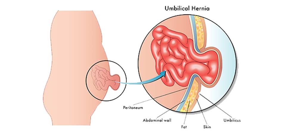 Umbilical-Hernia-Weight-Loss-Surgery-Institute-1